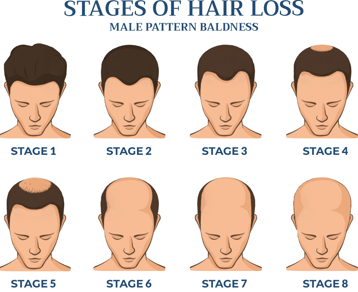 Hair Loss In Men Male Hair Loss Cranial Prosthesis Center