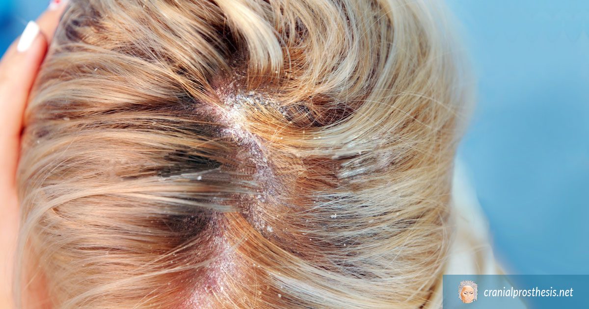 Exactly What Causes A Sensitive Scalp?