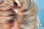 What Causes Sensitive Scalp?