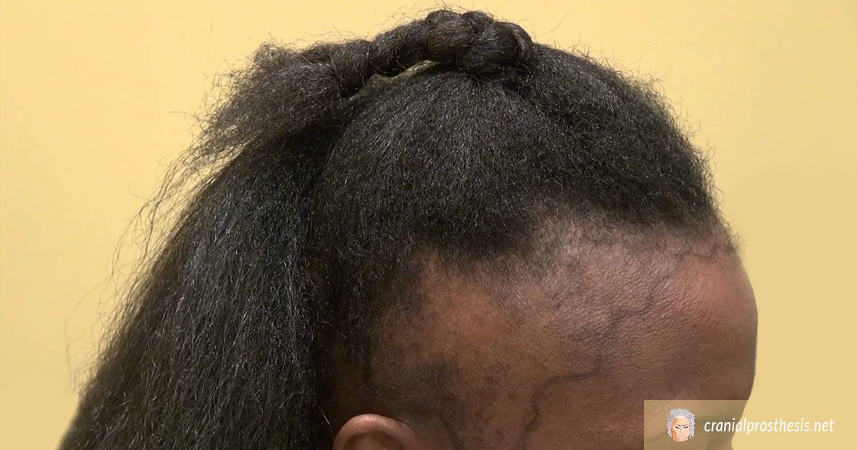 Types Of Alopecia Areata and Definitions