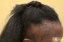 Types Of Alopecia Areata