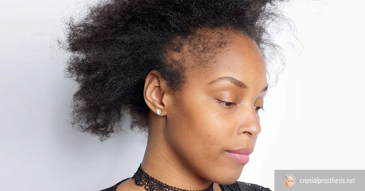 What You Should Know About Alopecia