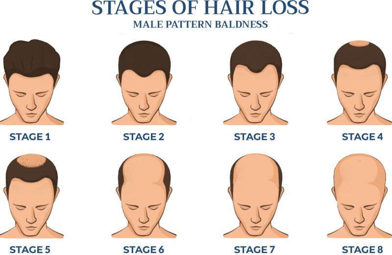 CranialProsthesis.net Male Pattern Baldness